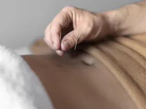 acupuncture